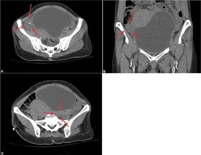 What Happens If Ovaries Are Not Visualized?