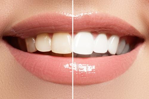 How To Get Shiny Teeth?