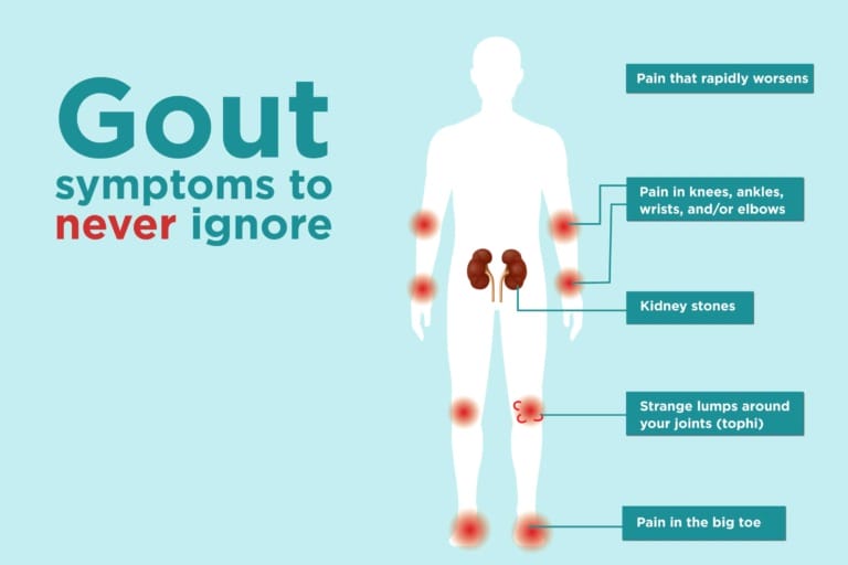 What is a Gout Attack? Symptoms, Causes, and Treatments